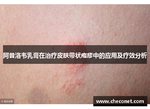 阿昔洛韦乳膏在治疗皮肤带状疱疹中的应用及疗效分析