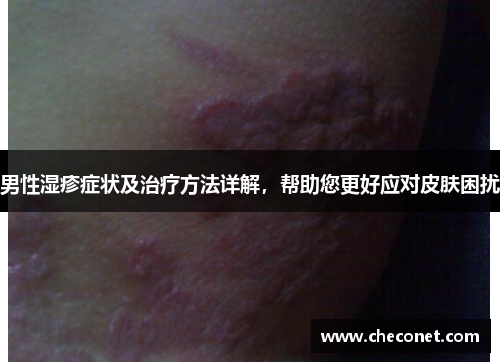 男性湿疹症状及治疗方法详解，帮助您更好应对皮肤困扰